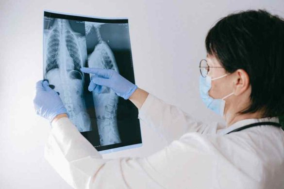 Cancer du poumon avancé : les symptômes souvent ignorés