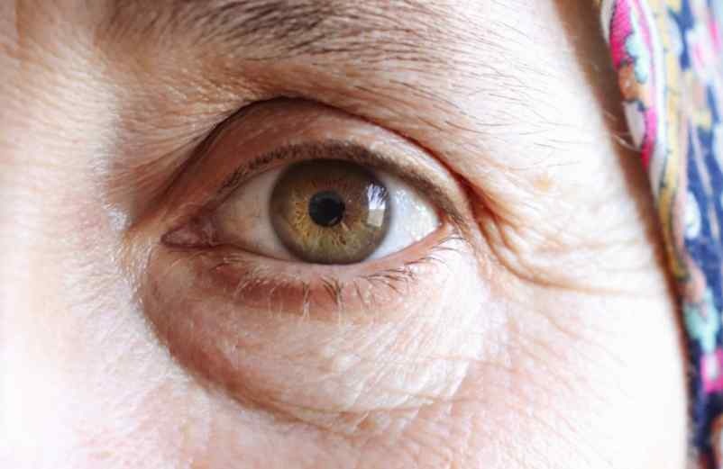 Paupière tombante : quelles solutions naturelles pour l’atténuer ? OrdMed Santé